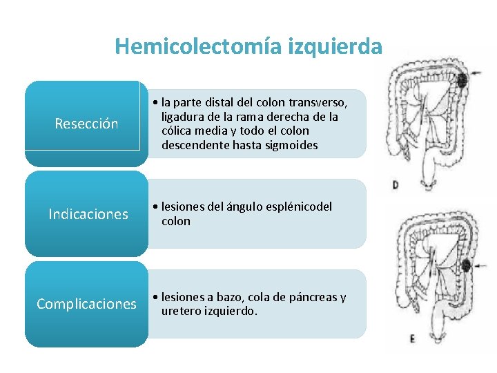 Hemicolectomía izquierda Resección Indicaciones • la parte distal del colon transverso, ligadura de la Hemicolectomía izquierda Resección Indicaciones • la parte distal del colon transverso, ligadura de la