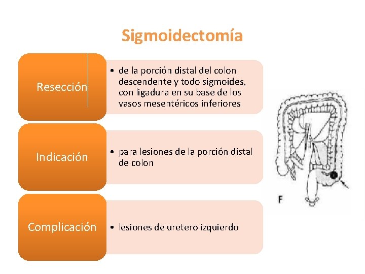 Sigmoidectomía Resección • de la porción distal del colon descendente y todo sigmoides, con Sigmoidectomía Resección • de la porción distal del colon descendente y todo sigmoides, con