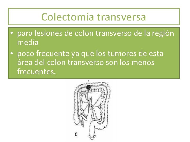 Colectomía transversa • para lesiones de colon transverso de la región media • poco Colectomía transversa • para lesiones de colon transverso de la región media • poco