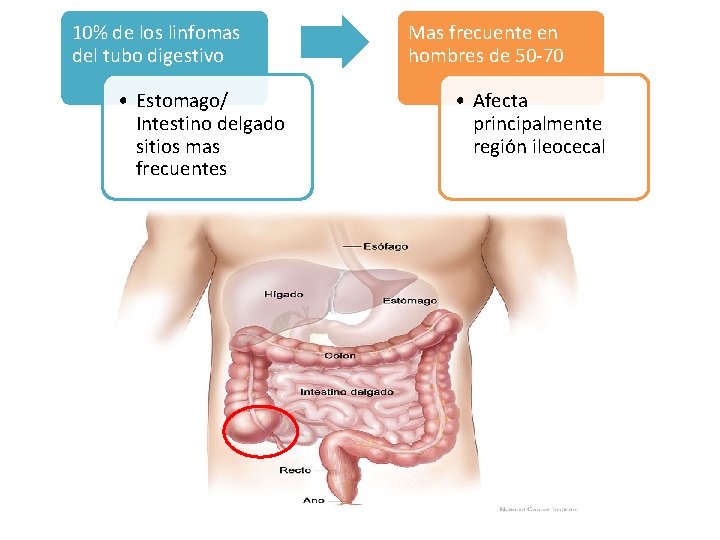 10% de los linfomas del tubo digestivo • Estomago/ Intestino delgado sitios mas frecuentes 10% de los linfomas del tubo digestivo • Estomago/ Intestino delgado sitios mas frecuentes