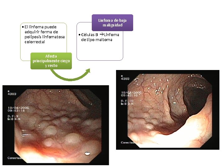 • El linfoma puede adquirir forma de poliposis linfomatosa colorrectal Afecta principalmente ciego • El linfoma puede adquirir forma de poliposis linfomatosa colorrectal Afecta principalmente ciego