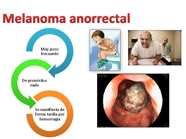 Melanoma anorrectal Muy poco frecuente De pronóstico malo Se manifiesta de forma tardía por Melanoma anorrectal Muy poco frecuente De pronóstico malo Se manifiesta de forma tardía por