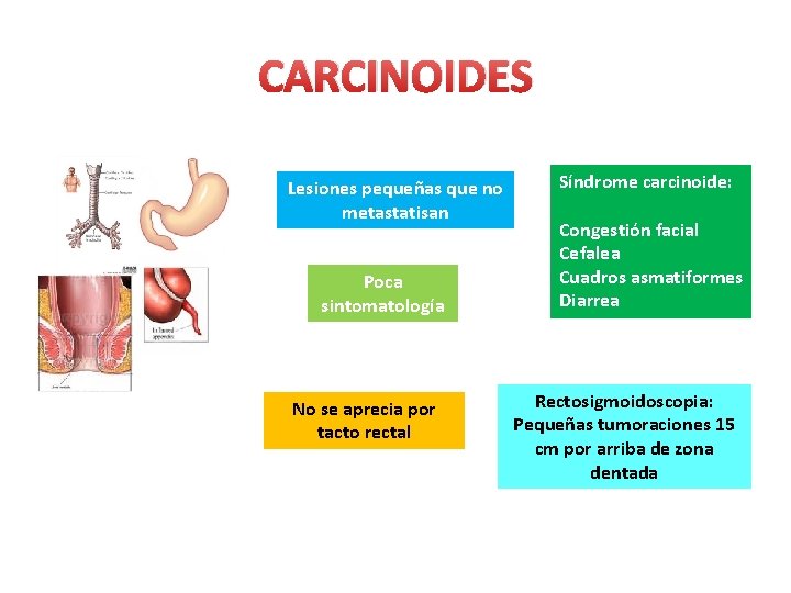 CARCINOIDES Lesiones pequeñas que no metastatisan Poca sintomatología No se aprecia por tacto rectal CARCINOIDES Lesiones pequeñas que no metastatisan Poca sintomatología No se aprecia por tacto rectal