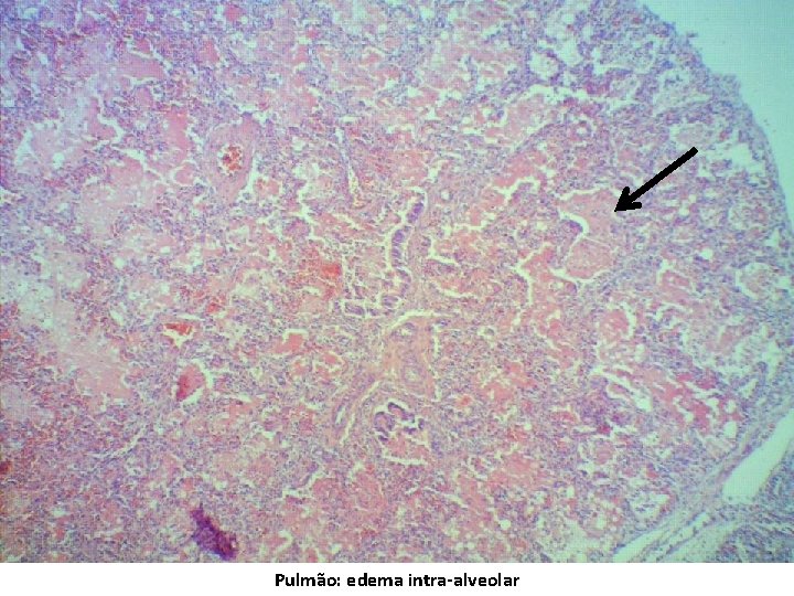 Pulmão: edema intra-alveolar 