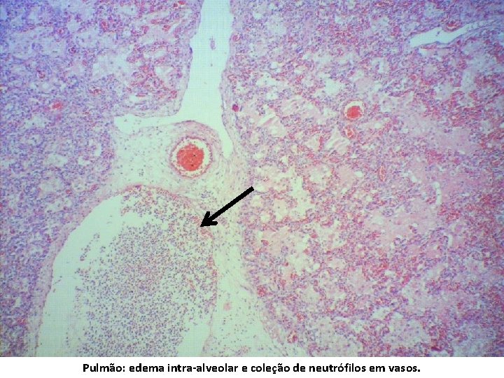 Pulmão: edema intra-alveolar e coleção de neutrófilos em vasos. 
