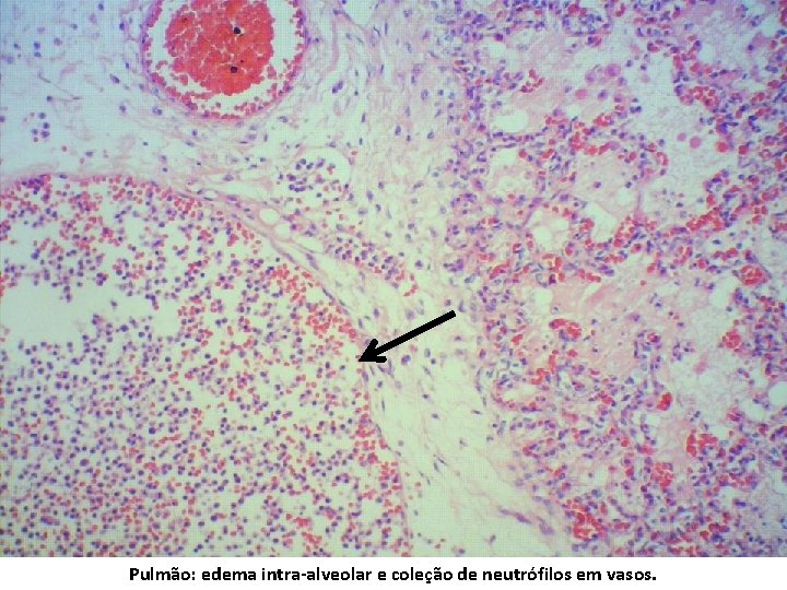 Pulmão: edema intra-alveolar e coleção de neutrófilos em vasos. 