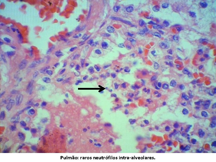 Pulmão: raros neutrófilos intra-alveolares. 