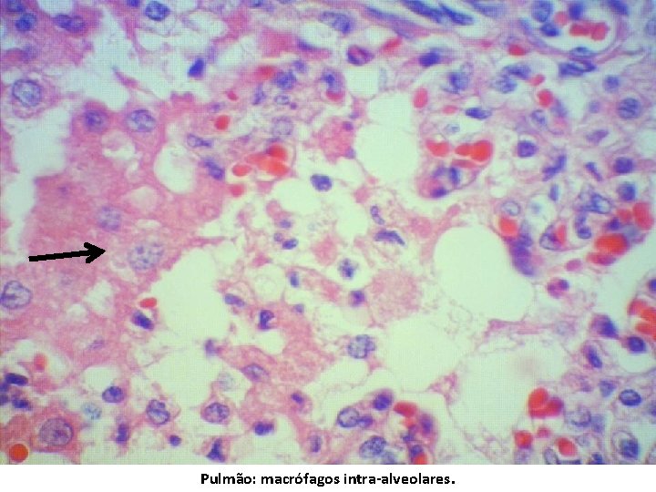 Pulmão: macrófagos intra-alveolares. 