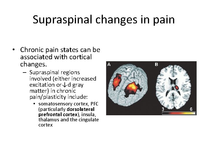 Supraspinal changes in pain • Chronic pain states can be associated with cortical changes.