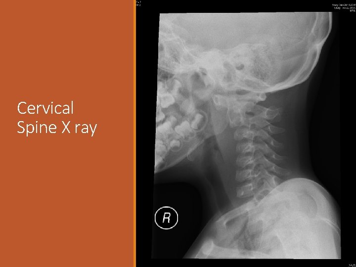 Cervical Spine X ray 