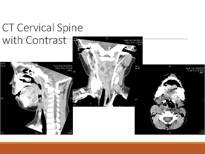 CT Cervical Spine with Contrast 