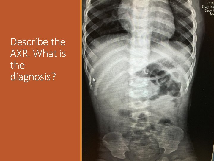 Describe the AXR. What is the diagnosis? 