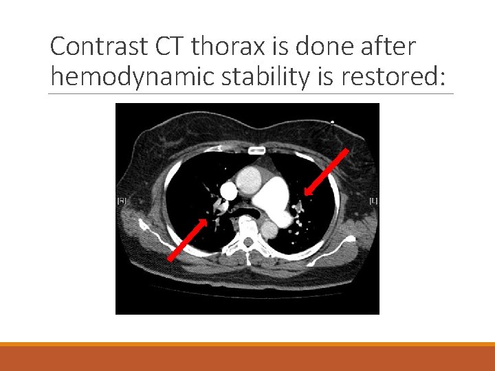 Contrast CT thorax is done after hemodynamic stability is restored: 