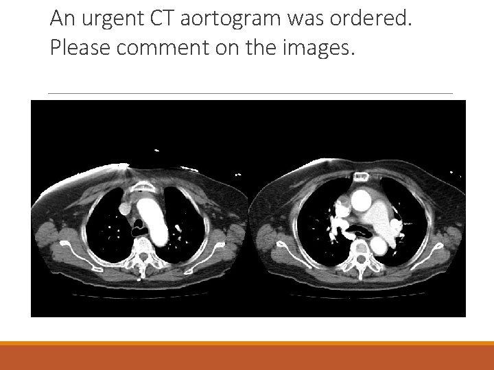An urgent CT aortogram was ordered. Please comment on the images. 