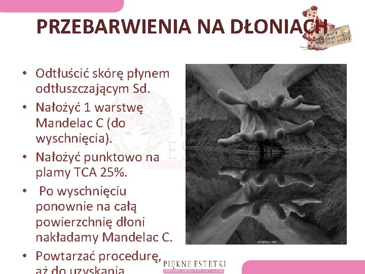 PRZEBARWIENIA NA DŁONIACH • Odtłuścić skórę płynem odtłuszczającym Sd. • Nałożyć 1 warstwę Mandelac