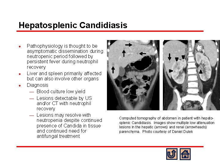 Hepatosplenic Candidiasis l l l Pathophysiology is thought to be asymptomatic dissemination during neutropenic