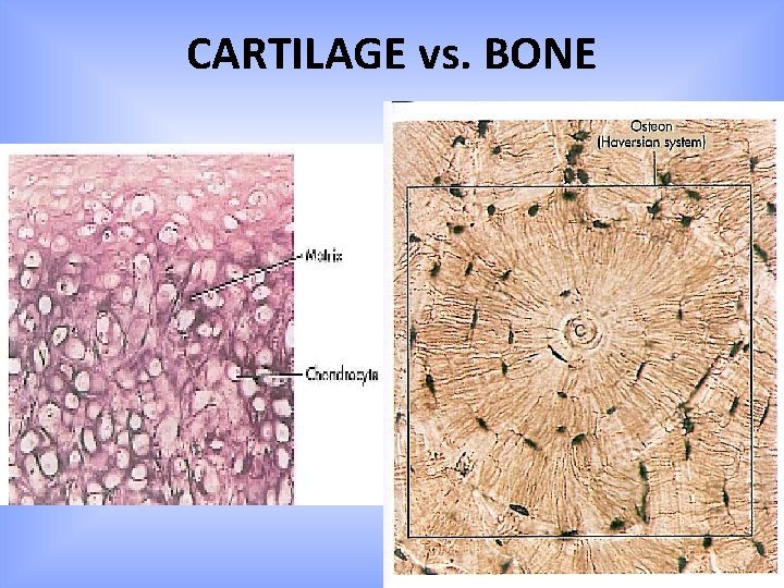 CARTILAGE vs. BONE 