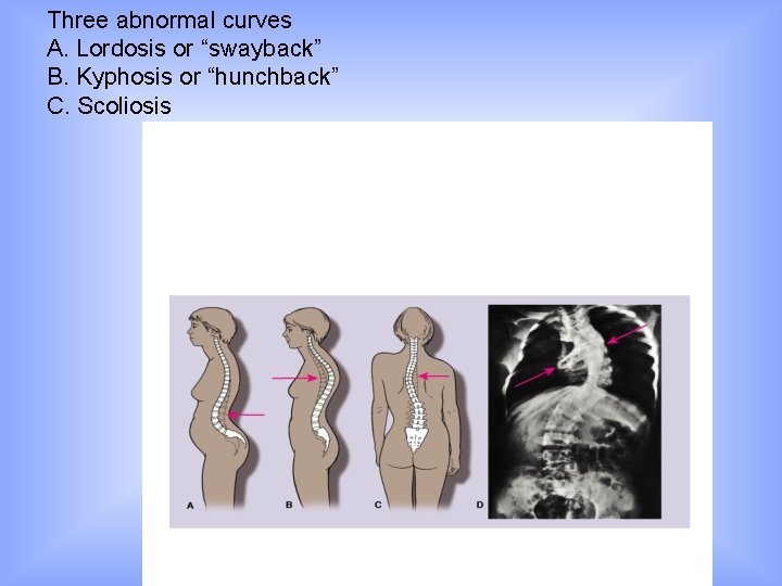 Three abnormal curves A. Lordosis or “swayback” B. Kyphosis or “hunchback” C. Scoliosis 