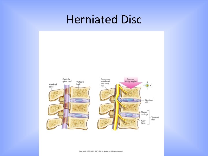 Herniated Disc 