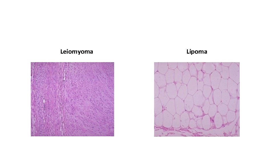 Leiomyoma Lipoma 