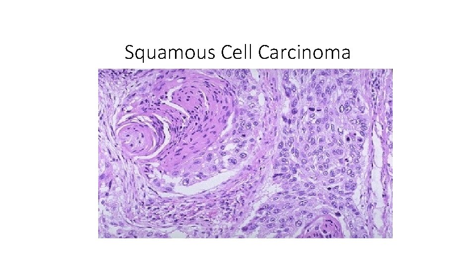 Squamous Cell Carcinoma Squamous Cell Carcinoma