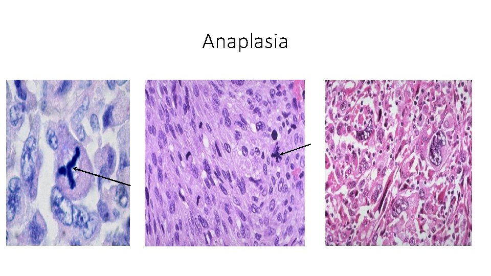 Anaplasia 