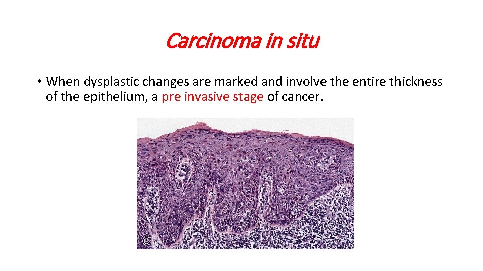 Carcinoma in situ • When dysplastic changes are marked and involve the entire thickness