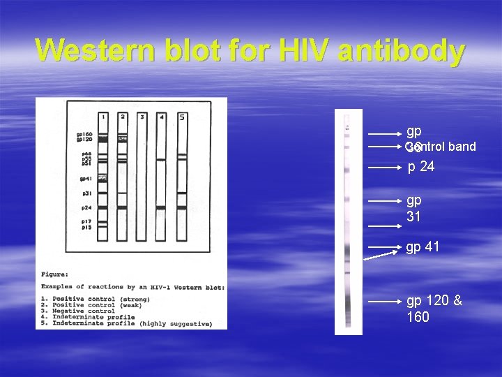 Western blot for HIV antibody gp Control band 36 p 24 gp 31 gp