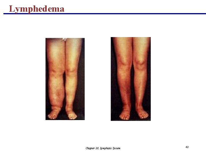 Lymphedema Chapter 20, Lymphatic System 42 