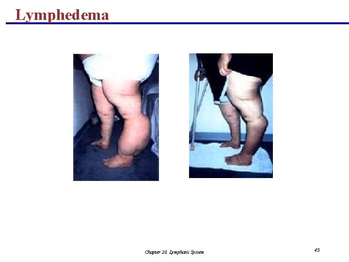 Lymphedema Chapter 20, Lymphatic System 43 