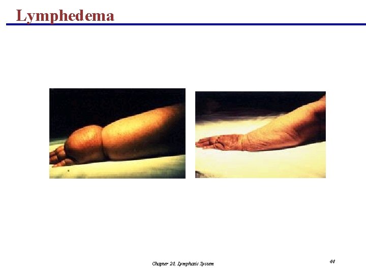 Lymphedema Chapter 20, Lymphatic System 44 