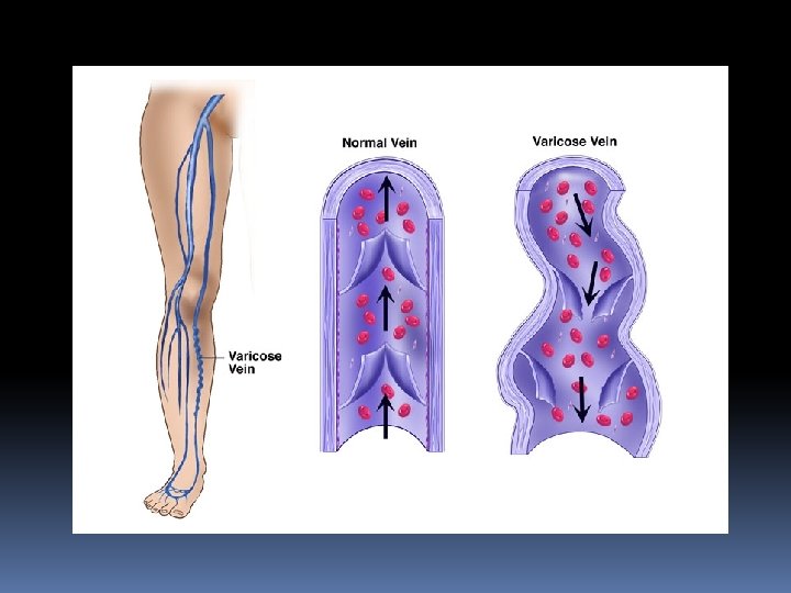perforating veins and varicose