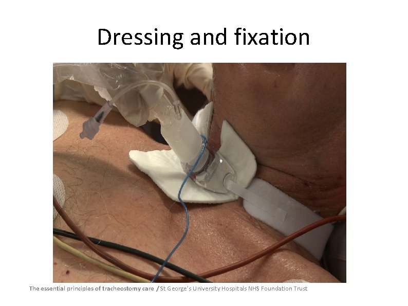 Dressing and fixation The essential principles of tracheostomy care / St George’s University Hospitals