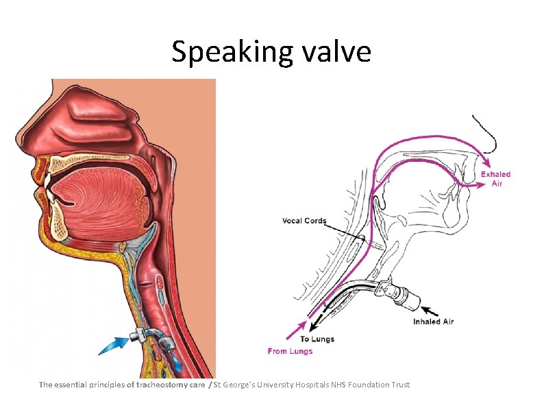 Speaking valve The essential principles of tracheostomy care / St George’s University Hospitals NHS