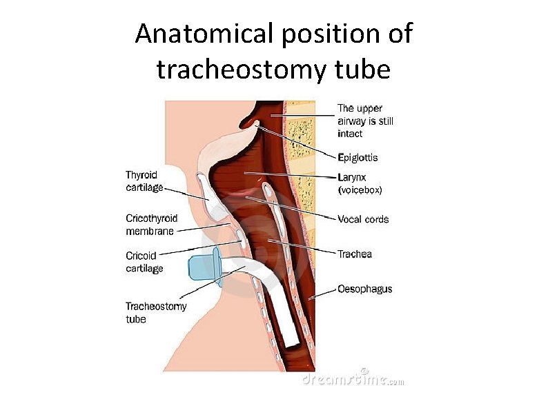 Anatomical position of tracheostomy tube 