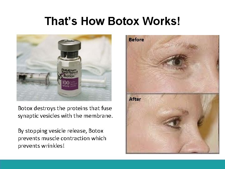 That’s How Botox Works! Before After Botox destroys the proteins that fuse synaptic vesicles