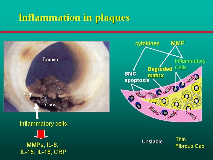 Inflammation in plaques cytokines Lumen MMP Inflammatory Degraded Cells SMC matrix apoptosis Cap Core