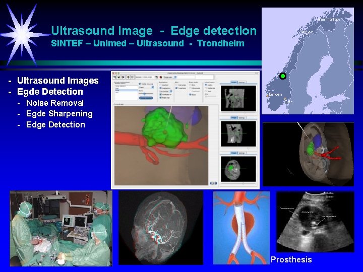 Ultrasound Image - Edge detection SINTEF – Unimed – Ultrasound - Trondheim - Ultrasound