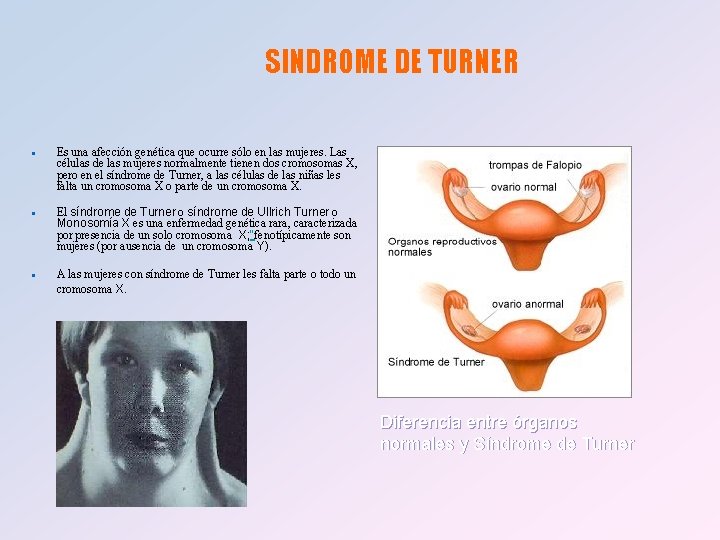 SINDROME DE TURNER n n n Es una afección genética que ocurre sólo en