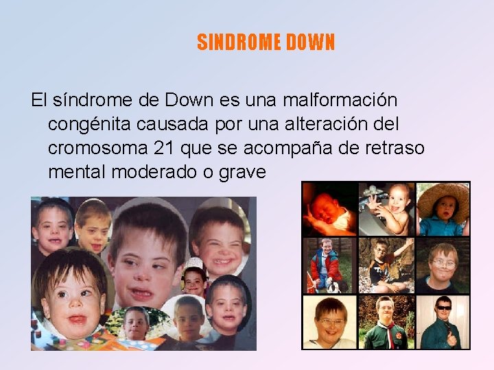 SINDROME DOWN El síndrome de Down es una malformación congénita causada por una alteración