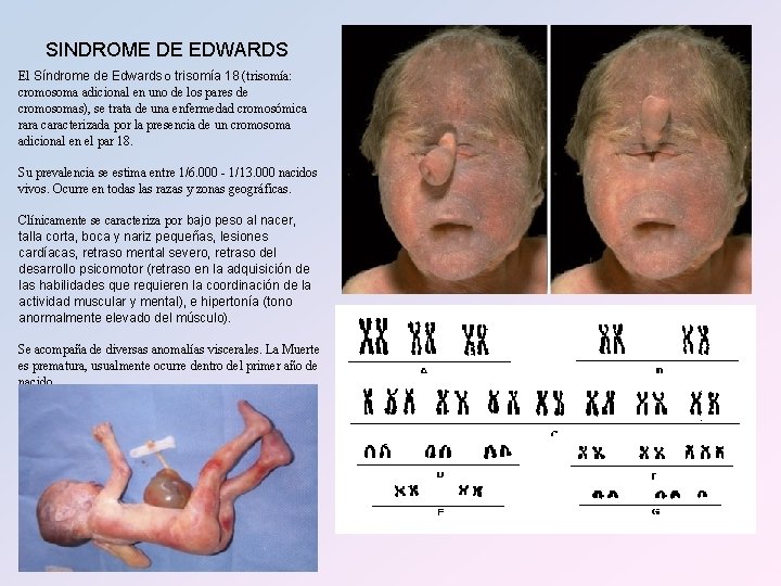 SINDROME DE EDWARDS El Síndrome de Edwards o trisomía 18 (trisomía: cromosoma adicional en