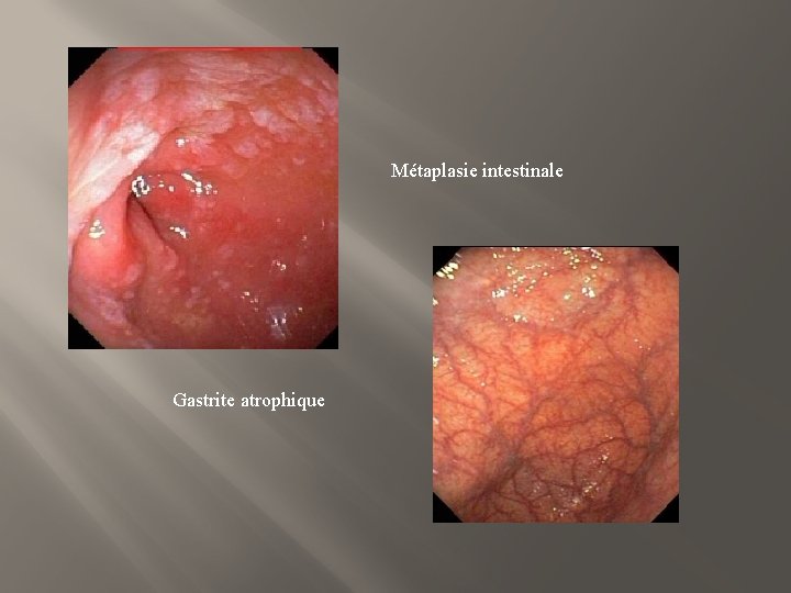 Métaplasie intestinale Gastrite atrophique 