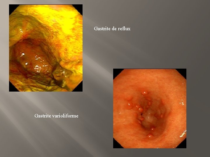 Gastrite de reflux Gastrite varioliforme 
