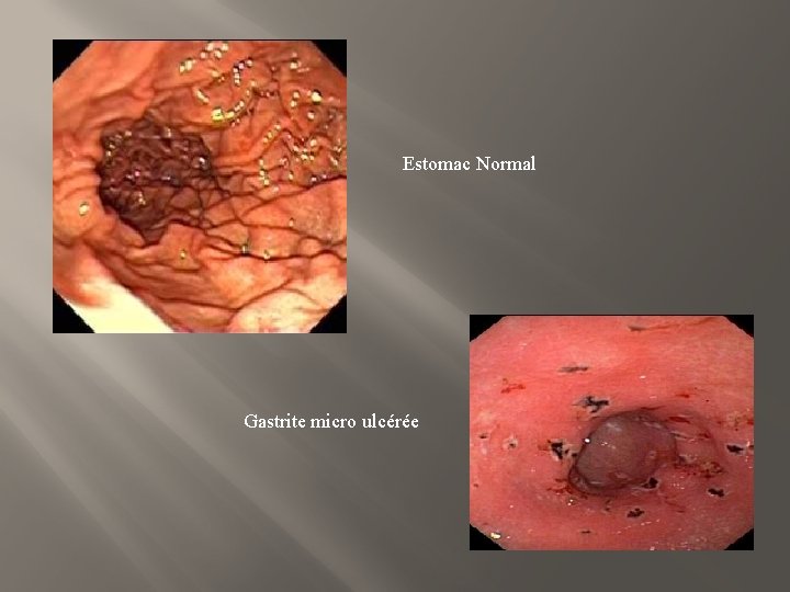 Estomac Normal Gastrite micro ulcérée 
