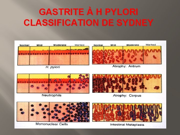 GASTRITE À H PYLORI CLASSIFICATION DE SYDNEY 