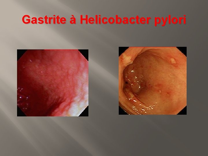 Gastrite à Helicobacter pylori 