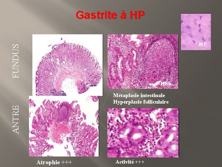 Gastrite à HP FUNDUS HP HES HE ANTRE S Atrophie +++ Métaplasie intestinale Hyperplasie