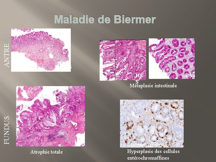 Maladie de Biermer HES HE S Métaplasie intestinale FUNDUS ANTRE � HES Atrophie totale