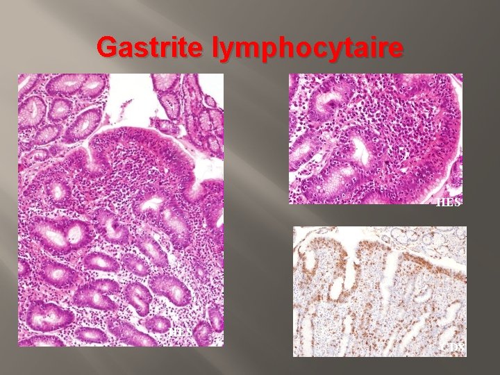 Gastrite lymphocytaire HES CD 8 