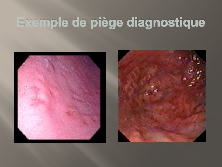 Exemple de piège diagnostique 